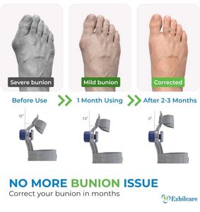 Bunion Corrector Splint Brace pain relief