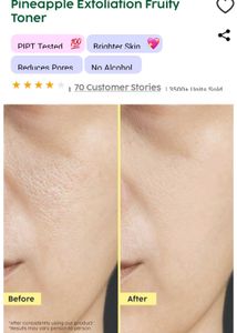 MRP - 399 Plix Pineapple Exfoliation Fruity Toner