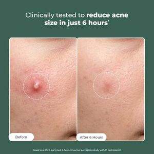Acne Spot Treatment - Reduce Size in 6 Hours
