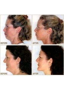 Chin Slimmer New Unused