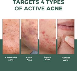 Acne Spot Treatment - Reduce Size in 6 Hours
