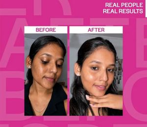 SUROSKIE Spotless TXA Capsule Cream