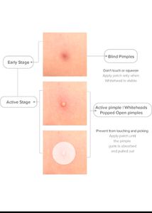 2 Combo Invisible Acne Pimple Patch