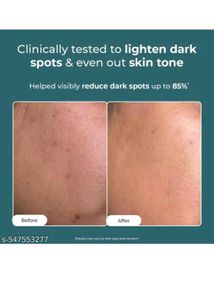 kojic acid face cream
