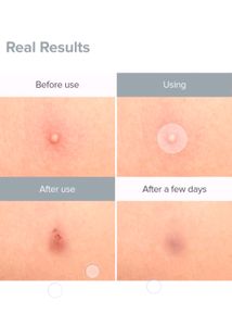 Priveda Pimple Patches