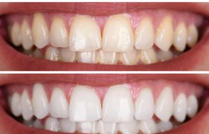 Teeth Whitening Charcoal Powder