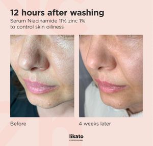 Likato Professional Niacinamide &amp; Zinc Serum
