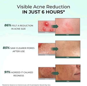 Acne Spot Treatment - Reduce Size in 6 Hours