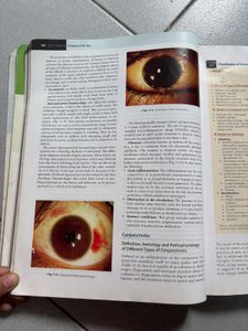 Parsons' Eye: Diseases of the Eye - 23rd Edition