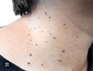 Skin Tag Remover