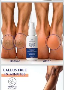 MANNLICH Callus Remover Spray