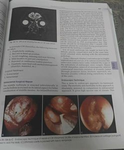 Textbook of ENT Hazarika