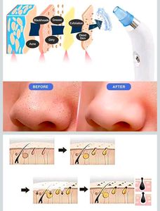 DermaSuction Pore Cleaning Device