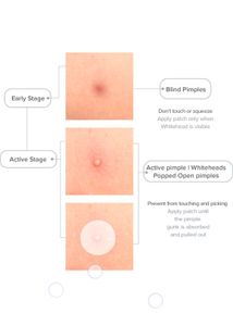 Priveda Pimple Patches
