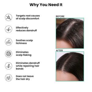 Pack Of 2 Salicylic Acid Shampoo