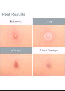 2 Combo Invisible Acne Pimple Patch
