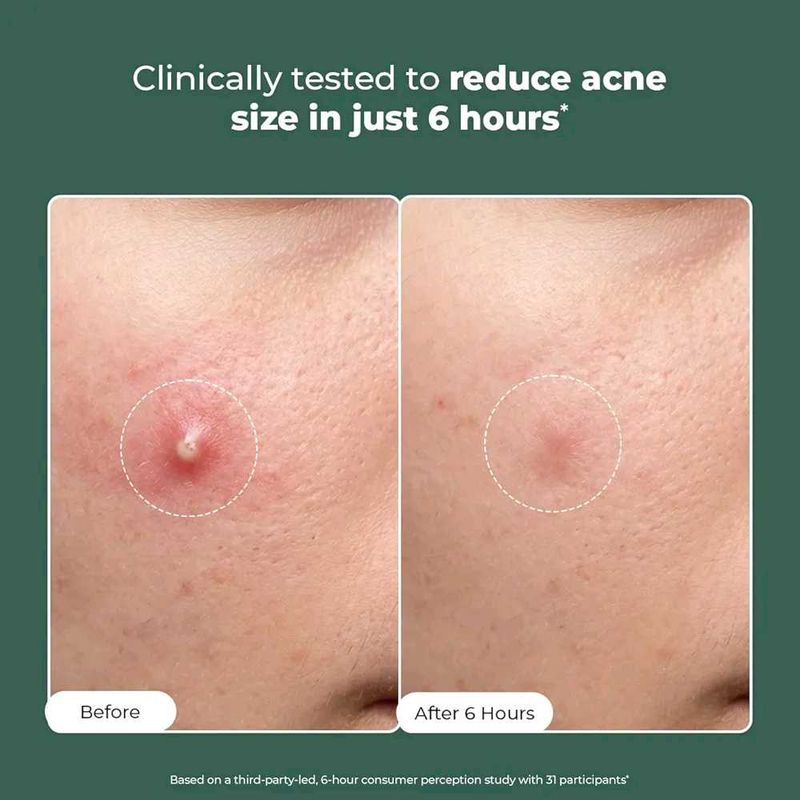 Acne Spot Treatment - Reduce Size in 6 Hours
